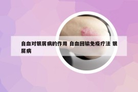 自血对银屑病的作用 自血回输免疫疗法 银屑病