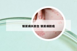 银屑病长脓包 银屑病脓疱