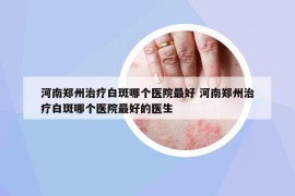 河南郑州治疗白斑哪个医院最好 河南郑州治疗白斑哪个医院最好的医生