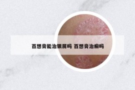 百想膏能治银屑吗 百想膏治癣吗