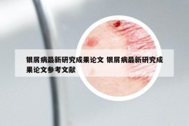 银屑病最新研究成果论文 银屑病最新研究成果论文参考文献