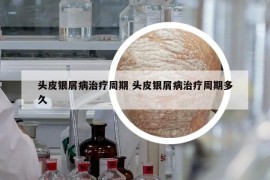 头皮银屑病治疗周期 头皮银屑病治疗周期多久