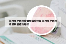 郑州哪个医院看银屑病疗效好 郑州哪个医院看银屑病疗效好些