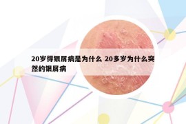 20岁得银屑病是为什么 20多岁为什么突然的银屑病