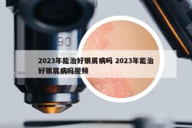 2023年能治好银屑病吗 2023年能治好银屑病吗视频
