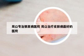 周口专治银屑病医院 周口治疗皮肤病最好的医院