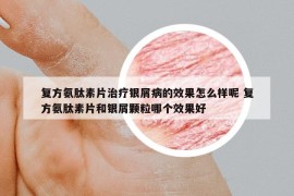 复方氨肽素片治疗银屑病的效果怎么样呢 复方氨肽素片和银屑颗粒哪个效果好