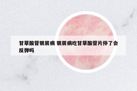 甘草酸苷银屑病 银屑病吃甘草酸苷片停了会反弹吗