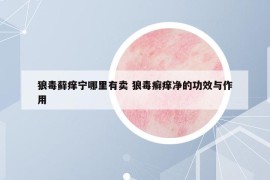 狼毒藓痒宁哪里有卖 狼毒癣痒净的功效与作用