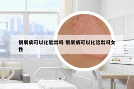 银屑病可以化验出吗 银屑病可以化验出吗女性