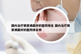 国内治疗银屑病最好的医院排名 国内治疗银屑病最好的医院排名榜