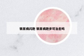 银屑病闪跑 银屑病跑步可治愈吗