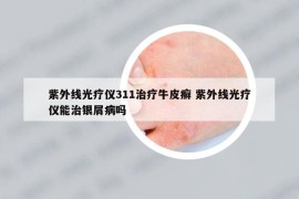 紫外线光疗仪311治疗牛皮癣 紫外线光疗仪能治银屑病吗