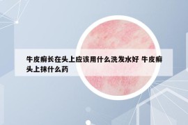牛皮癣长在头上应该用什么洗发水好 牛皮癣头上抹什么药