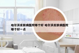 哈尔滨皮肤病医院哪个好 哈尔滨皮肤病医院哪个好一点