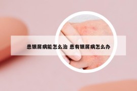 患银屑病能怎么治 患有银屑病怎么办