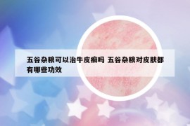 五谷杂粮可以治牛皮癣吗 五谷杂粮对皮肤都有哪些功效