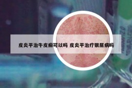 皮炎平治牛皮癣可以吗 皮炎平治疗银屑病吗