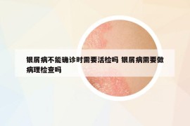 银屑病不能确诊时需要活检吗 银屑病需要做病理检查吗