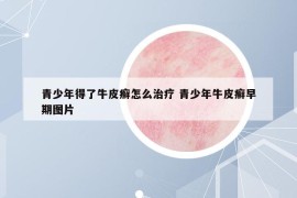 青少年得了牛皮癣怎么治疗 青少年牛皮癣早期图片