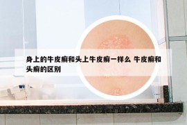 身上的牛皮癣和头上牛皮癣一样么 牛皮癣和头癣的区别