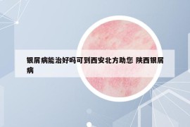 银屑病能治好吗可到西安北方助您 陕西银屑病