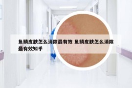 鱼鳞皮肤怎么消除最有效 鱼鳞皮肤怎么消除最有效知乎