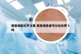 银屑病能吃罗汉果 银屑病患者可以吃白萝卜吗
