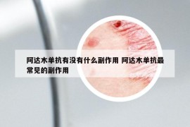 阿达木单抗有没有什么副作用 阿达木单抗最常见的副作用