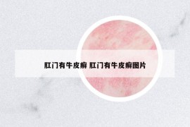 肛门有牛皮癣 肛门有牛皮癣图片