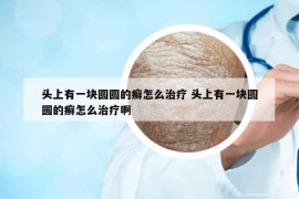 头上有一块圆圆的癣怎么治疗 头上有一块圆圆的癣怎么治疗啊
