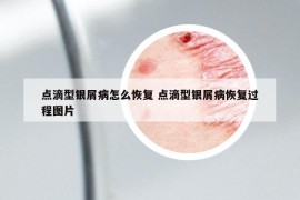 点滴型银屑病怎么恢复 点滴型银屑病恢复过程图片