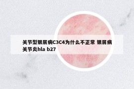 关节型银屑病C3C4为什么不正常 银屑病关节炎hla b27