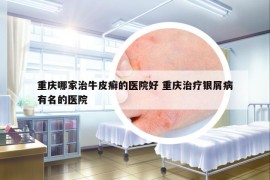 重庆哪家治牛皮癣的医院好 重庆治疗银屑病有名的医院