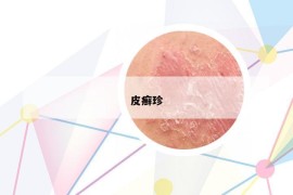 皮癣珍