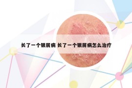 长了一个银屑病 长了一个银屑病怎么治疗