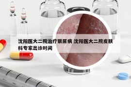 沈阳医大二院治疗银屑病 沈阳医大二院皮肤科专家出诊时间