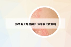 怀孕会长牛皮癣么 怀孕会长皮癣吗