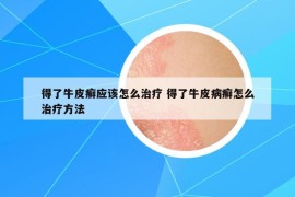 得了牛皮癣应该怎么治疗 得了牛皮病癣怎么治疗方法