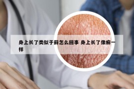 身上长了类似于藓怎么回事 身上长了像癣一样