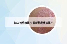 脸上长癣的图片 脸部长癣症状图片