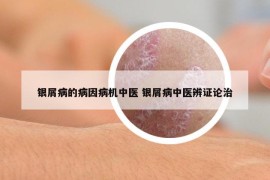银屑病的病因病机中医 银屑病中医辨证论治