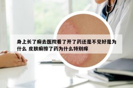 身上长了癣去医院看了开了药还是不见好是为什么 皮肤癣擦了药为什么特别痒