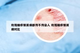 玫瑰糠疹银屑病都传不传染人 玫瑰糠疹银屑病对比