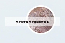 牛皮癣扩散 牛皮肤癣会扩散 吗