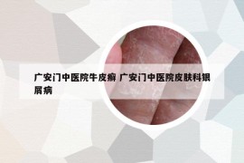 广安门中医院牛皮癣 广安门中医院皮肤科银屑病