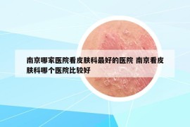 南京哪家医院看皮肤科最好的医院 南京看皮肤科哪个医院比较好