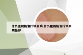 什么医院能治疗银屑病 什么医院能治疗银屑病最好