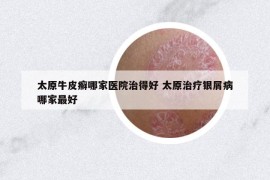 太原牛皮癣哪家医院治得好 太原治疗银屑病哪家最好
