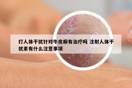 打人体干扰针对牛皮癣有治疗吗 注射人体干扰素有什么注意事项